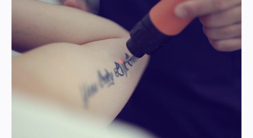 Laser Tattoo Entfernung - Dr. Kaan Harmankaya - Hautarzt Wien 1010