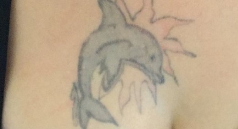 Laser Tattoo Entfernung - Dr. Kaan Harmankaya - Hautarzt Wien 1010