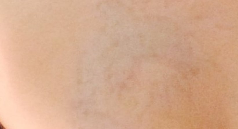 Laser Tattoo Entfernung - Dr. Kaan Harmankaya - Hautarzt Wien 1010