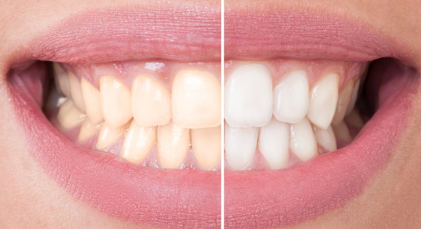 Bleaching - Dr. med.dent. Jochen Leidl - Zahnarzt Mattersburg 7210