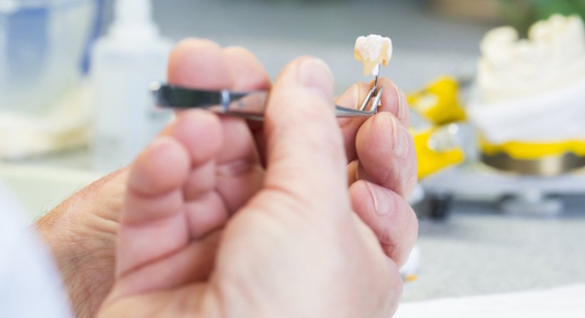 Inlay / Onlay / Overlay - Dr. med.dent. Jochen Leidl - Zahnarzt Mattersburg 7210