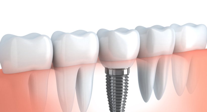 Knochenaufbau - Dr. med.dent. Jochen Leidl - Zahnarzt Mattersburg 7210