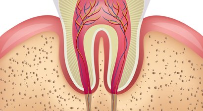 Wurzelspitzenresektion