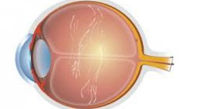 Laser-Vitreolyse - fliegende Mücken schonend entfernen