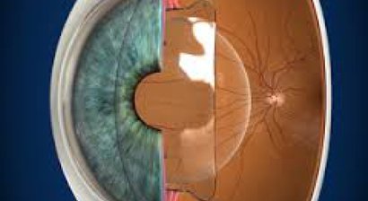 Phake Linsenchirurgie - Die sichere Alternative zur LASIK