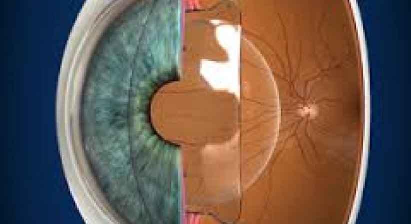 Phake Linsenchirurgie - Die sichere Alternative zur LASIK - Dr. Matthias Maus - Augenarzt Wien 1010