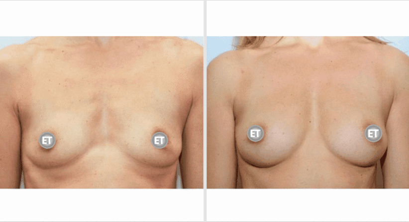 Brustvergrößerung mit Eigenfett - Univ.Prof. Dr. Edvin Turkof - Plastischer Chirurg Wien 1060