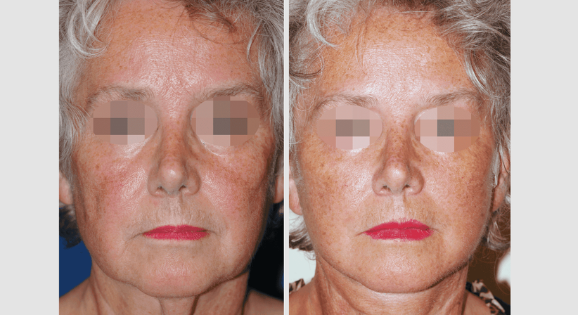 Facelift - Univ.Prof. Dr. Edvin Turkof - Plastischer Chirurg Wien 1060