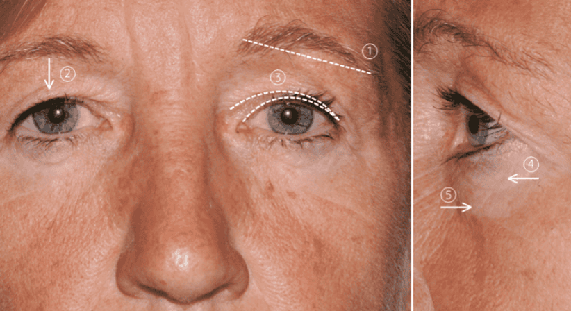 Augenlidstraffung - Univ.Prof. Dr. Edvin Turkof - Plastischer Chirurg Wien 1060