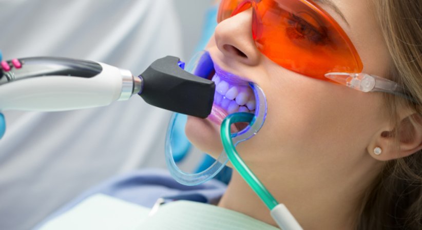 Bleaching - Dr. Reza Homayuni - Zahnarzt Wien 1010