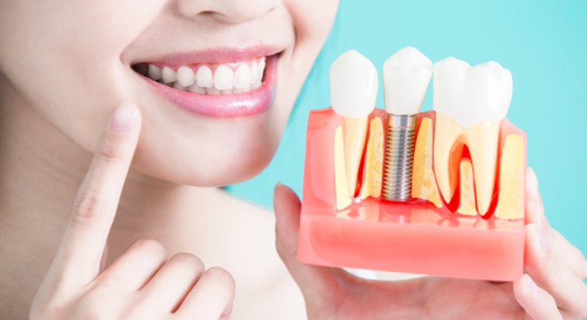 Implantate / Knochenaufbau - Dr. Reza Homayuni - Zahnarzt Wien 1010
