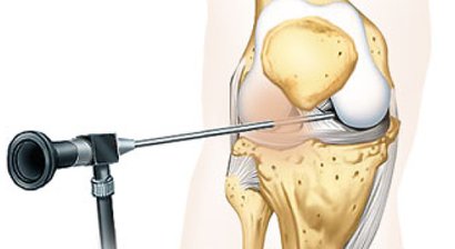 Gelenkspieglungen (Arthroskopien) Knie und Schulter