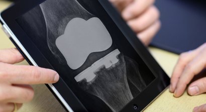 Gonarthrose / Knieprothese