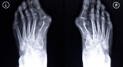 Hallux valgus