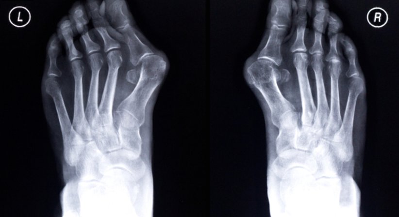 Hallux valgus - Univ.Doz. Dr. Martin Buchelt - Orthopäde Wien 1190