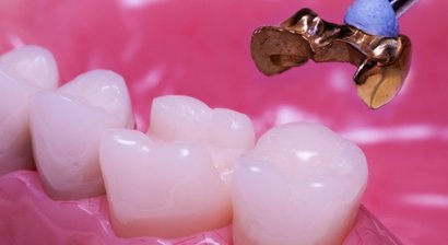 Kronen- und Brücken