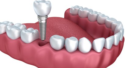 Zahnimplantate