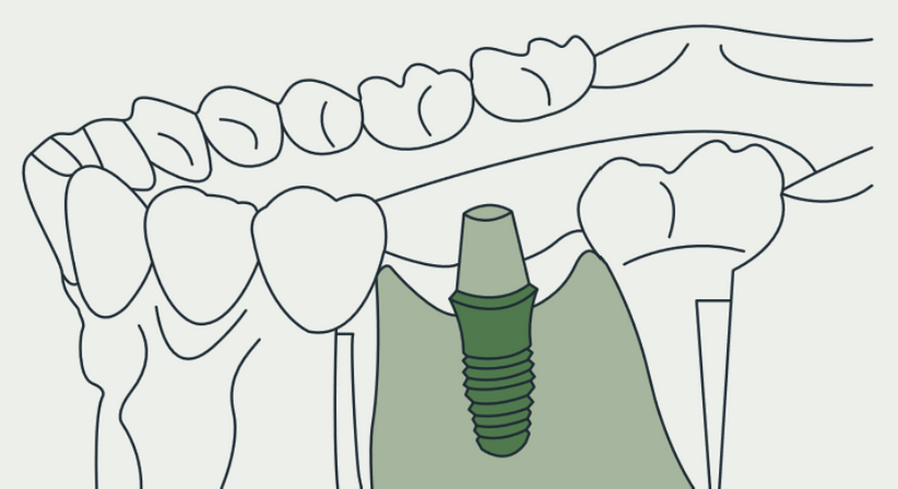 Implantate - DDDr. Armin Sokolowski - Zahnarzt Kumberg 8062