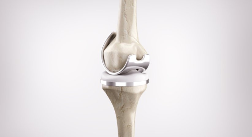 Knieprothese - Assoc.-Prof. Priv.-Doz. Dr. Marcus Hofbauer - Unfallchirurg Wien 1190