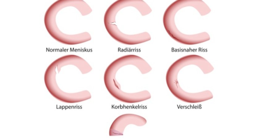 Meniskusriss - Assoc.-Prof. Priv.-Doz. Dr. Marcus Hofbauer - Unfallchirurg Wien 1190