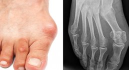 Hallux Valgus Korrektur -