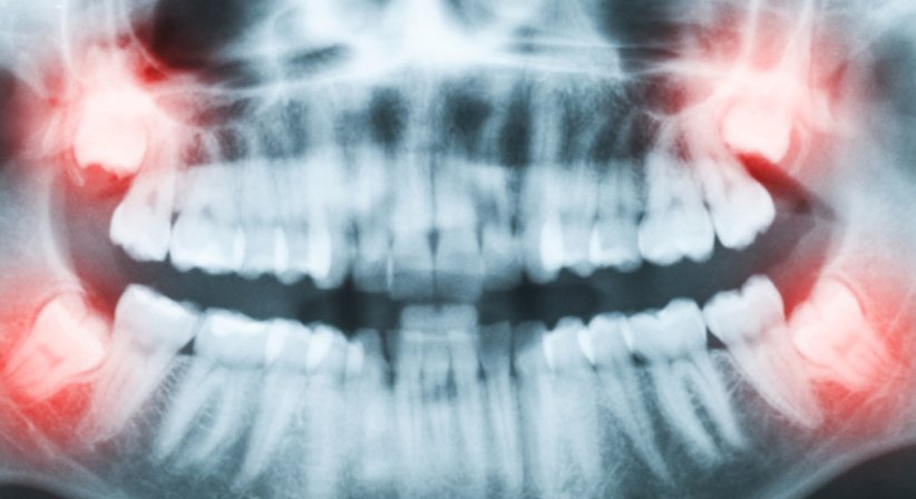 3D  Röntgen - Dr. Thomas Cede - Zahnarzt Wien 1010