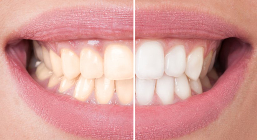 Bleaching - Dr. Thomas Cede - Zahnarzt Wien 1010