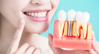 Zahnimplantate und Knochenaufbauten