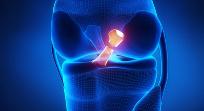 Ersatz des Kniegelenks: Knieoberflächenersatz, MyKnee Knieendoprothese