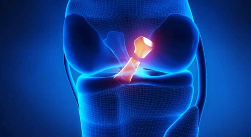 Ersatz des Kniegelenks: Knieoberflächenersatz, MyKnee Knieendoprothese - Dr. Alexander Zembsch - Orthopäde Wien 1130