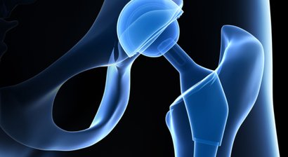 Hüftprothese minimal invasiv, Operation der Hüfte, AMIS-Methode