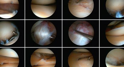 Minimal invasive Gelenkchirurgie, Arthroskopische Operationen