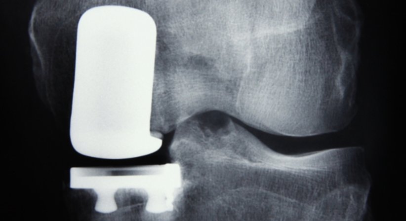 Kniechirurgie - Dr. Christian Klein - Orthopäde Mondsee 5310