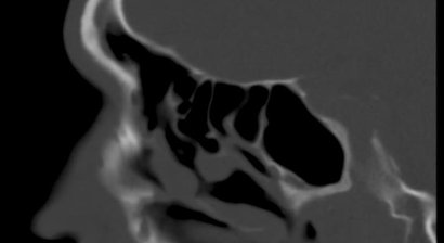 Nasennebenhöhlen- Endoskopie und Chirurgie