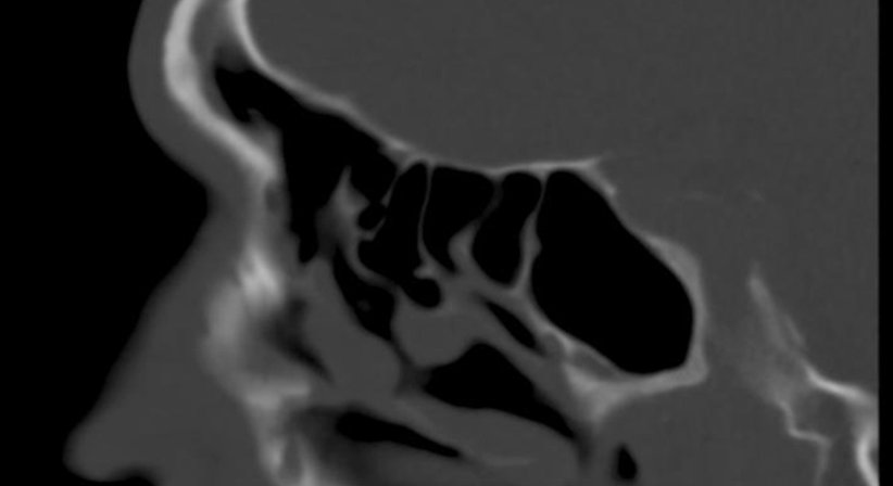 Nasennebenhöhlen- Endoskopie und Chirurgie - Assoc.Prof. Priv.Doz. Dr. Claudia Lill - HNO-Ärztin Wien 1180