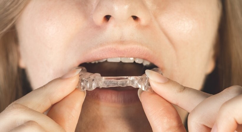 Knirsch-Schiene - Dr. Sabine Nahler - Zahnärztin Wien 1010