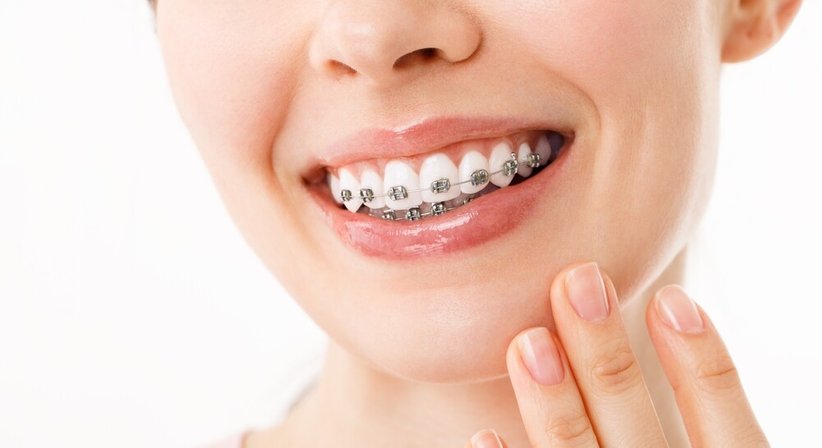 Festsitzende Zahnspangen (Brackets) - Dr. Sabine Nahler - Zahnärztin Wien 1010