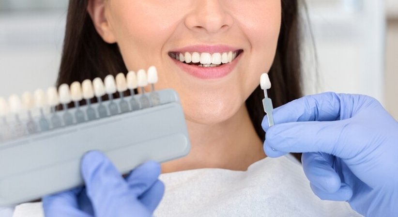 Zahnaufhellung & Bleaching - Dr. Sabine Nahler - Zahnärztin Wien 1010