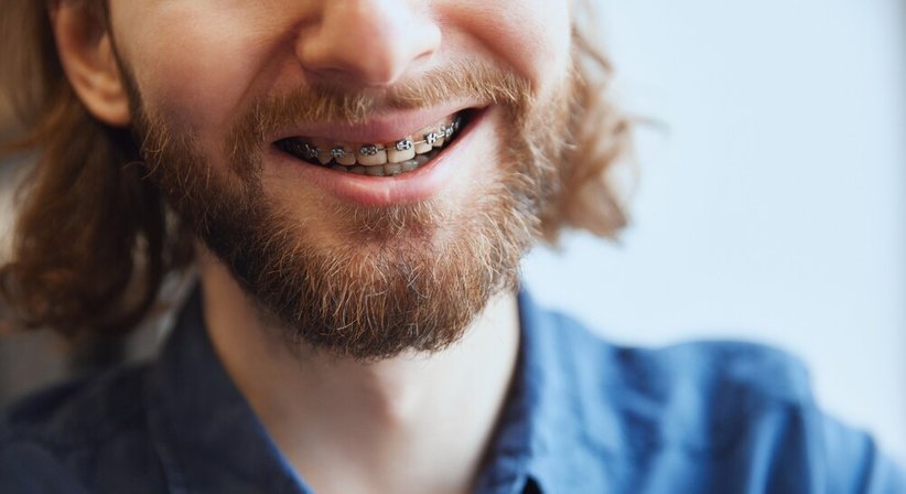 Zahnspangen für Erwachsene - Dr. Sabine Nahler - Zahnärztin Wien 1010