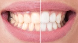 Bleaching -