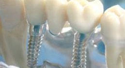 Implantat -