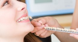 Veneers -