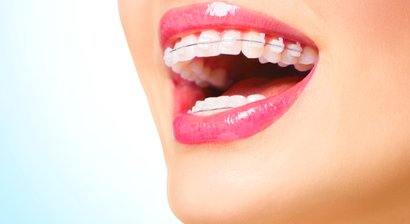 Festsitzende Zahnspangen