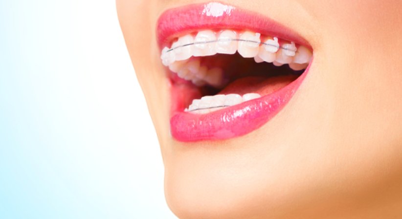 Festsitzende Zahnspangen - DDr. Maximilian Seemann - Zahnarzt Wien 1090