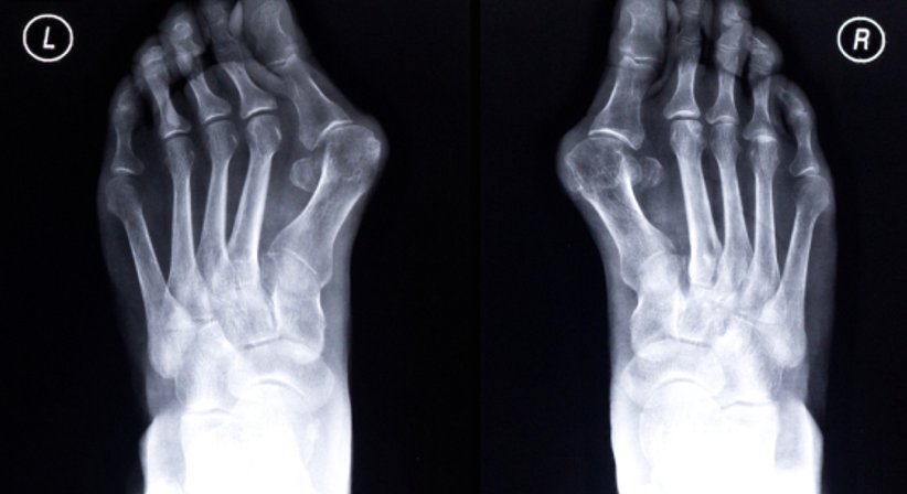 Hallux Valgus - OA Dr. Hans Peter Heuberger - Orthopäde Wiener Neustadt 2700