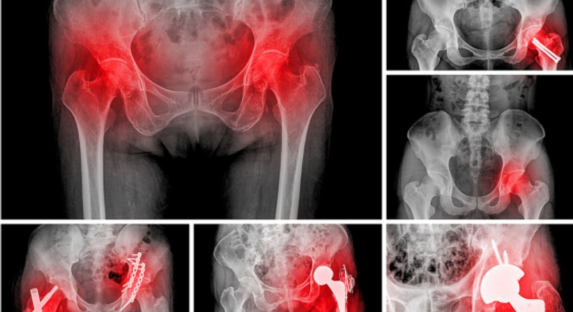 Hüftprothese - OA Dr. Hans Peter Heuberger - Orthopäde Wiener Neustadt 2700