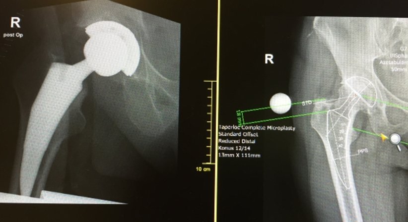 Hüftprothese - OA Dr. Hans Peter Heuberger - Orthopäde Wiener Neustadt 2700