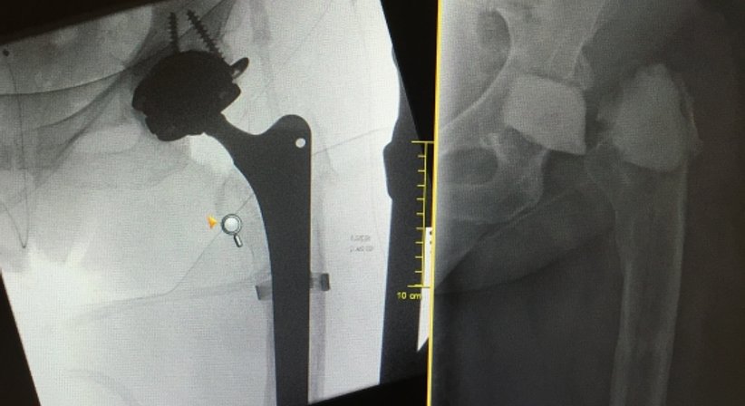 Wechsel von schmerzhaften oder infizierten Gelenksprothesen  - OA Dr. Hans Peter Heuberger - Orthopäde Wiener Neustadt 2700