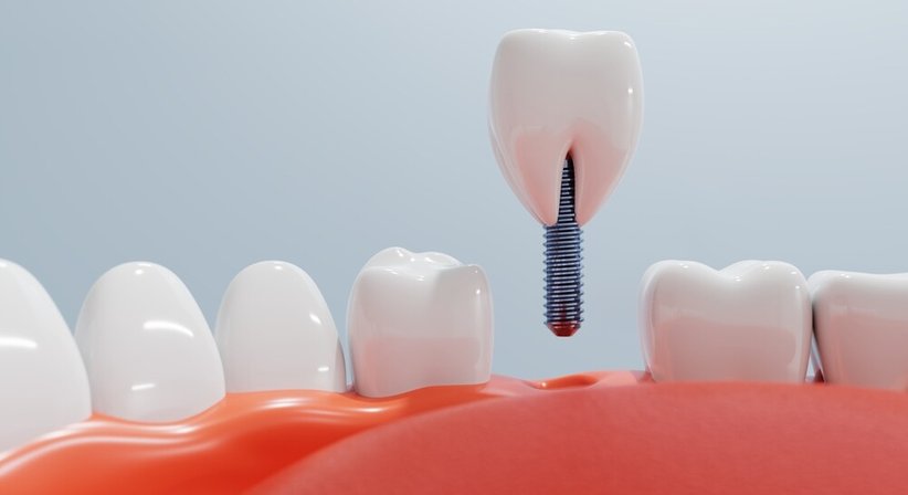 Implantologie - Dr. Lucas Nahler - Zahnarzt Wien 1010