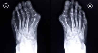 Hallux valgus